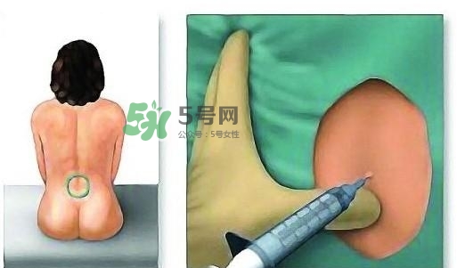 無痛分娩為什么不提倡？無痛分娩有后遺癥嗎？