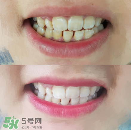 碧緹福美牙儀好用嗎？碧緹福美牙儀原理