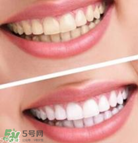 碧緹福美牙儀對(duì)牙齒有傷害嗎？碧緹福美牙儀會(huì)反彈嗎？