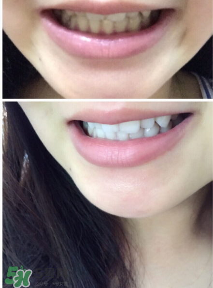 美牙儀能用水洗嗎？美牙儀能用多久？