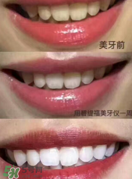 美牙儀能用水洗嗎？美牙儀能用多久？