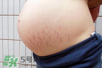 妊娠紋什么時(shí)候開始預(yù)防？妊娠紋什么時(shí)候消除？