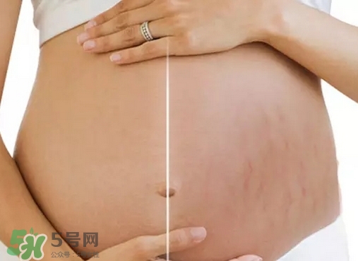 脖子上會長妊娠紋嗎？妊娠紋長在哪些地方？