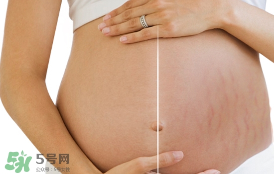 妊娠紋在左邊生男或女？怎么從妊娠紋看男女？