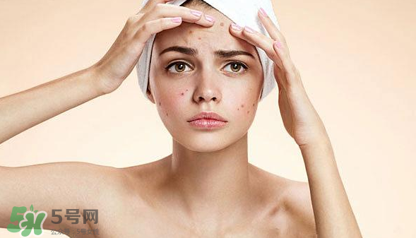 長痘長閉口怎么辦？長痘長閉口是什么原因？