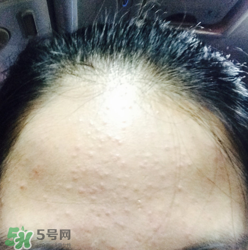 長痘長閉口怎么辦？長痘長閉口是什么原因？