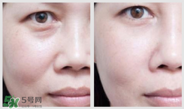 法令紋怎么消除？如何正確對待法令紋？