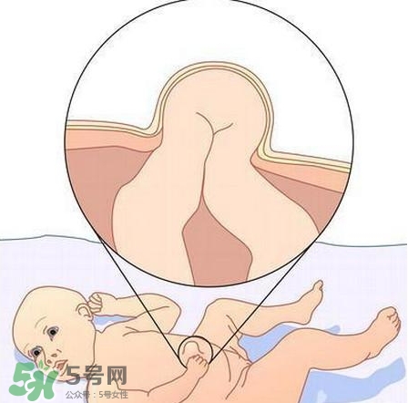 臍疝是什么？臍疝對寶寶有什么影響？