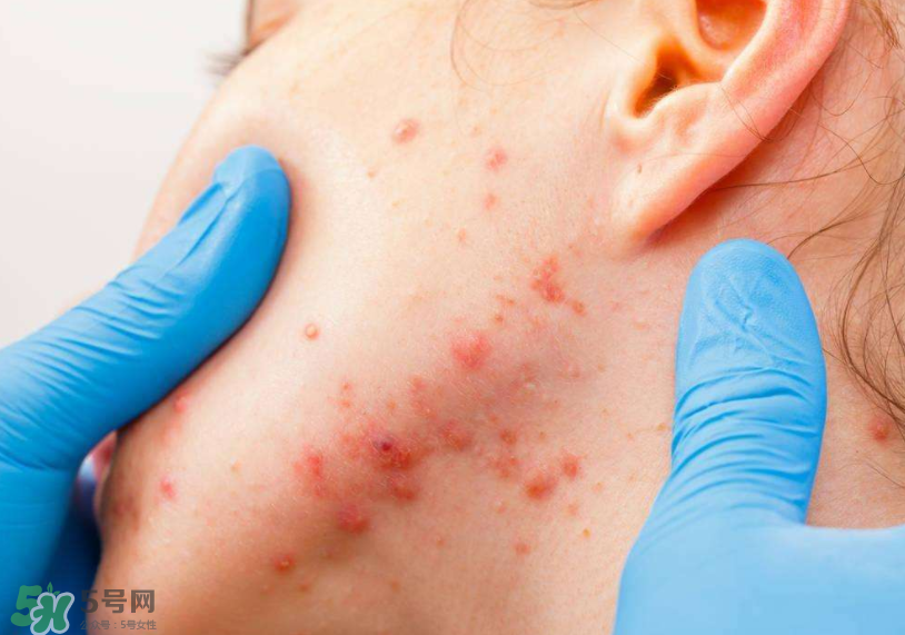 痤瘡的分類 痤瘡的護(hù)理原則 痤瘡的分類 痤瘡的護(hù)理原則