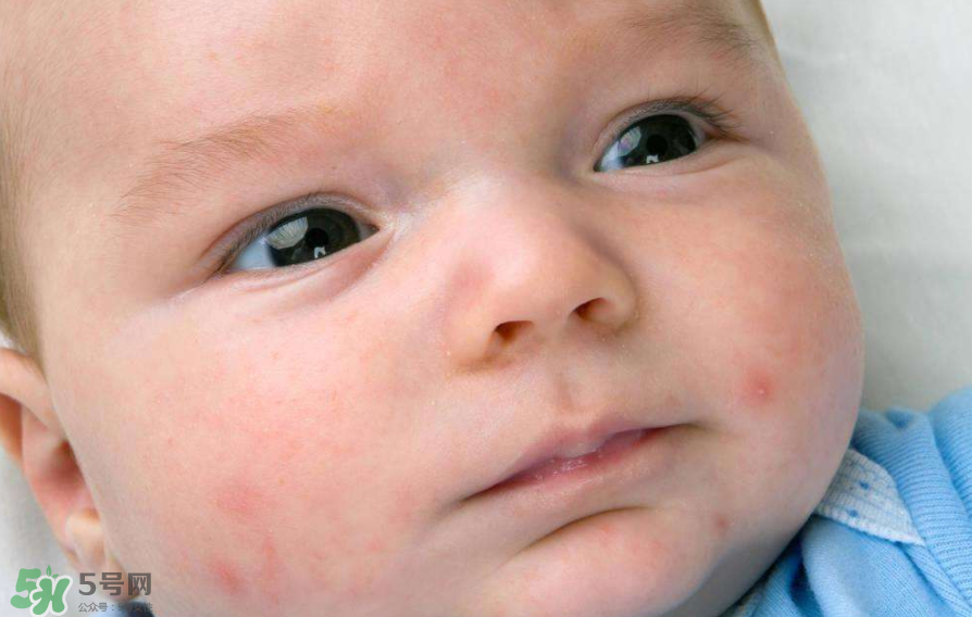 痤瘡的分類 痤瘡的護(hù)理原則 痤瘡的分類 痤瘡的護(hù)理原則