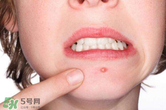 暗瘡可以擠壓?jiǎn)幔坑托院腕a臟肌膚會(huì)容易有暗瘡嗎？