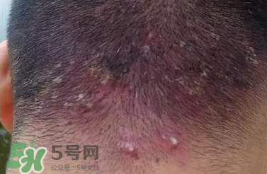 痤瘡和毛囊炎一樣嗎？痤瘡與毛囊炎區(qū)別