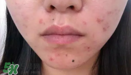 痤瘡和毛囊炎一樣嗎？痤瘡與毛囊炎區(qū)別