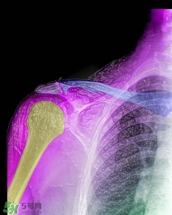 骨刺是怎么形成的？骨刺怎么治療？