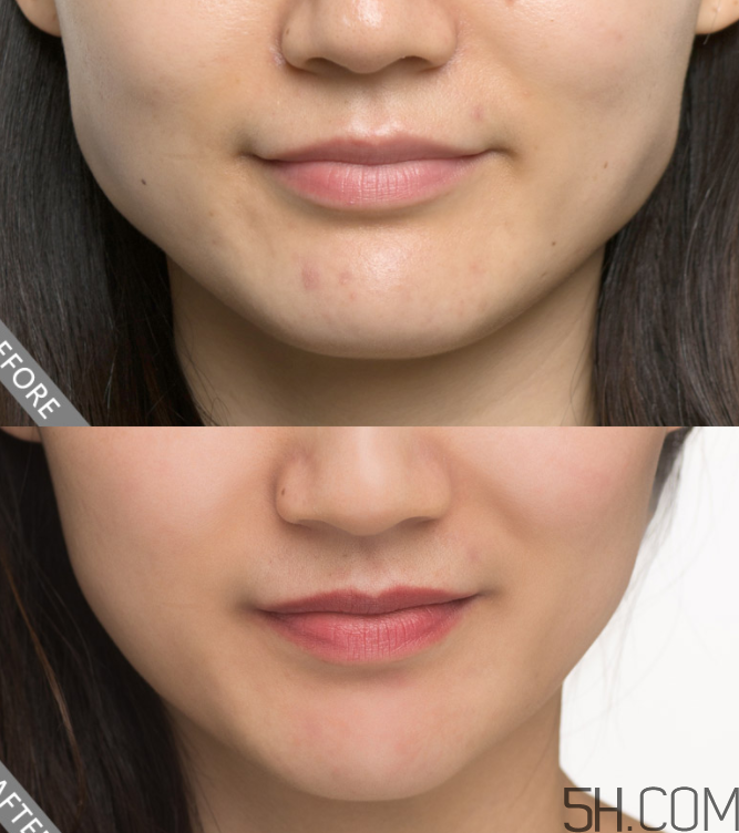 瘦臉針需要打幾次有效？瘦臉針需要打幾次定型？