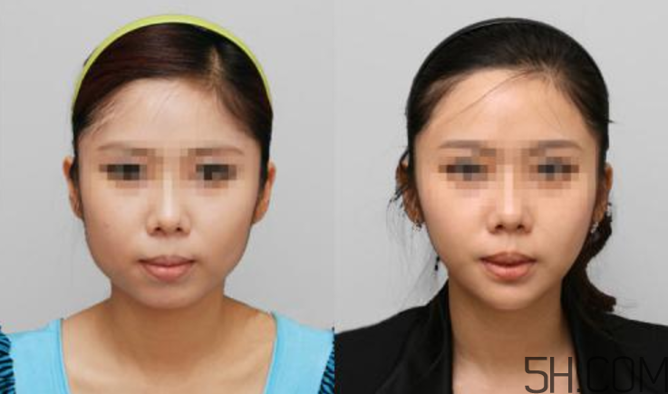 瘦臉針要做皮試嗎？瘦臉針皮試怎么做？