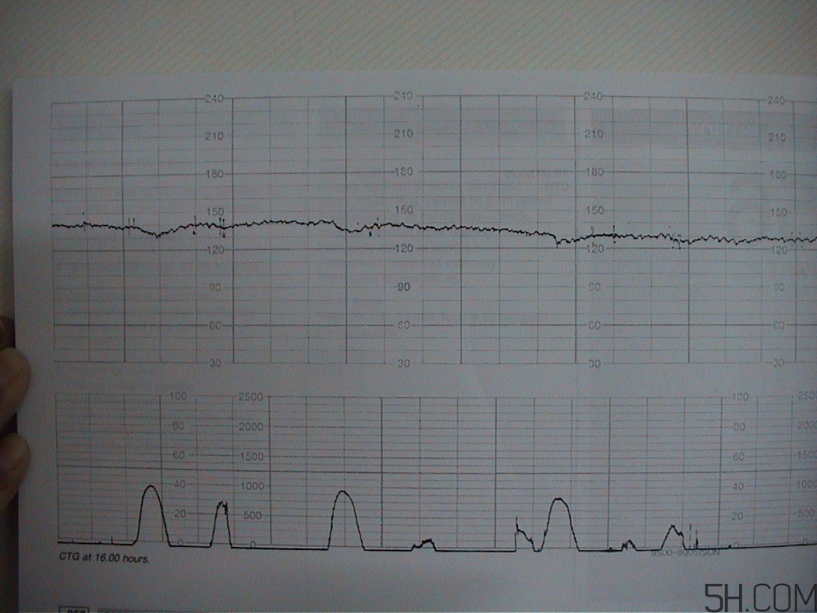為什么要做胎心監(jiān)護(hù)？孕婦做胎心監(jiān)護(hù)有什么用？