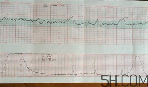 為什么要做胎心監(jiān)護(hù)？孕婦做胎心監(jiān)護(hù)有什么用？