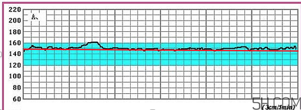 為什么要做胎心監(jiān)護(hù)？孕婦做胎心監(jiān)護(hù)有什么用？