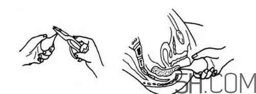 用開塞露會(huì)拉稀嗎？便秘用開塞露不管用怎么辦？