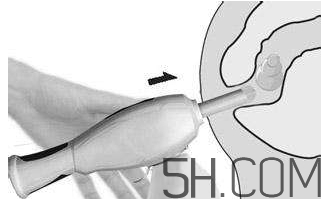 開塞露怎么用？開塞露用后多久會(huì)排便？