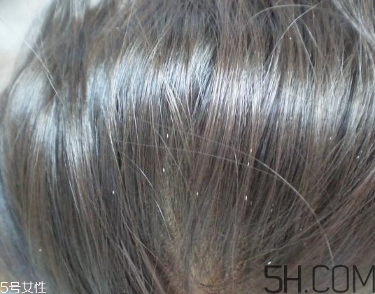 頭虱和頭皮屑怎么區(qū)分？頭虱是怎樣生成的