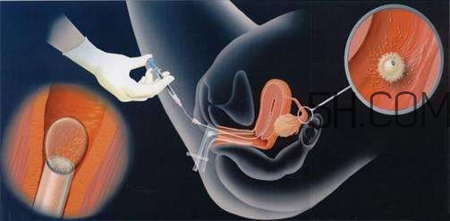 人工授精取卵子怎么取？人工授精男人怎樣取精？