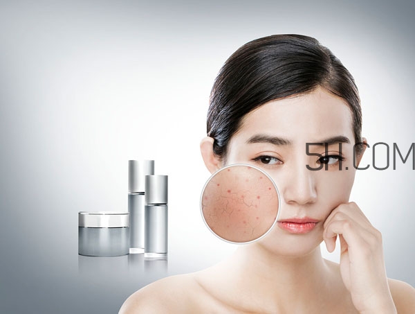 經(jīng)前暗瘡吃什么好 經(jīng)前暗瘡怎么調(diào)理 經(jīng)前暗瘡吃什么好 經(jīng)前暗瘡怎么調(diào)理