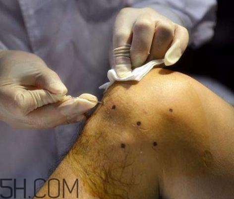 關(guān)節(jié)炎積液什么癥狀？關(guān)節(jié)炎積水怎么治療？