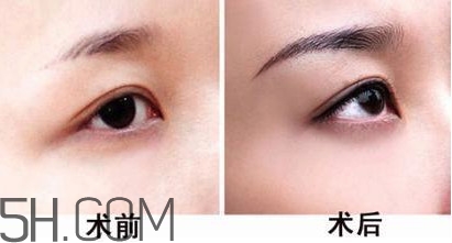 切眉手術(shù)后老得快嗎？切眉能保持多久？