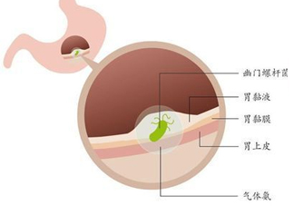 幽門螺桿菌的癥狀有哪些表現(xiàn)？幽門螺旋菌怎么治療
