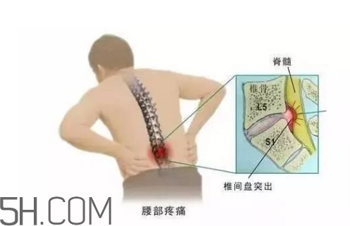 腰間盤突出是什么原因引起的？腰間盤突出是腎虛嗎