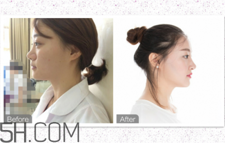 鼻頭縮小術(shù)過程圖 鼻頭縮小手術(shù)千萬別做后悔死