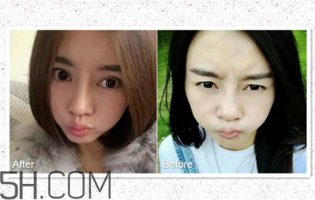 鼻頭縮小術(shù)過程圖 鼻頭縮小手術(shù)千萬別做后悔死