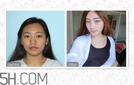 鼻頭縮小術(shù)過程圖 鼻頭縮小手術(shù)千萬別做后悔死