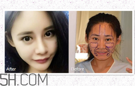 鼻頭縮小術(shù)過程圖 鼻頭縮小手術(shù)千萬別做后悔死