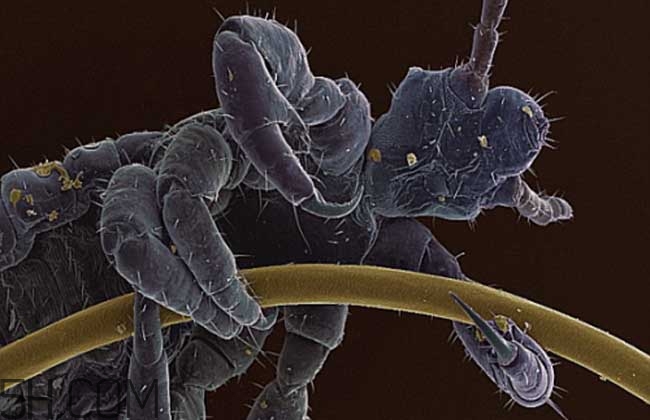 孩子長虱子是怎么回事？孩子長虱子該怎么辦？