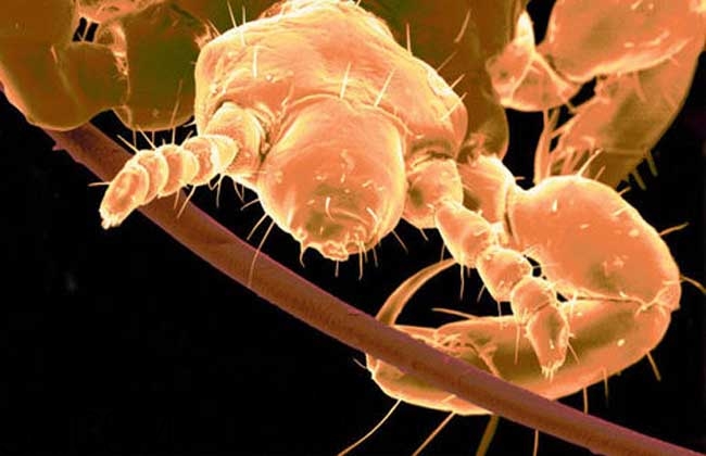 孩子長虱子是怎么回事？孩子長虱子該怎么辦？