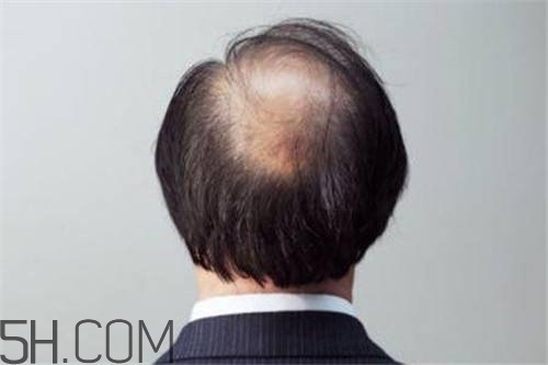 為什么男性比女性更容易脫發(fā)？什么原因?qū)е履行悦摪l(fā)？