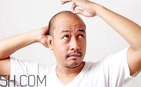 為什么男性比女性更容易脫發(fā)？什么原因?qū)е履行悦摪l(fā)？