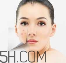 濕熱型痤瘡是什么？怎么調理濕熱型痤瘡？