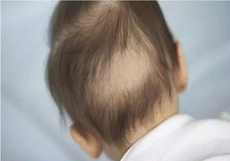 寶寶枕禿怎么辦？如何改善寶寶枕禿現(xiàn)象？