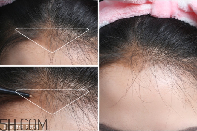 發(fā)際線不好看怎么修飾 完美解決6種發(fā)際線問(wèn)題 發(fā)際線不好看怎么修飾 完美解決6種發(fā)際線問(wèn)題