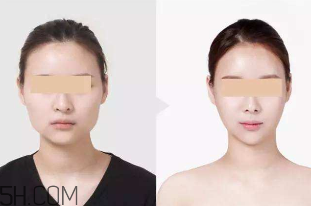 打瘦臉針可以抽煙嗎？打瘦臉針會反彈嗎？