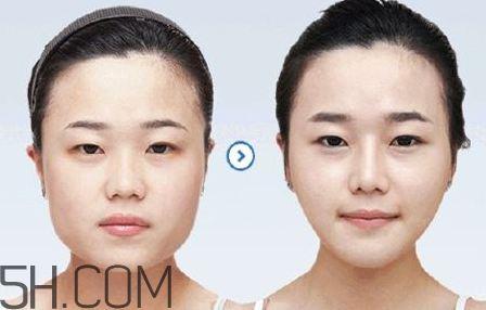 打瘦臉針可以抽煙嗎？打瘦臉針會反彈嗎？