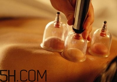 拔罐可以治療鼻炎嗎？鼻炎拔罐拔哪里？