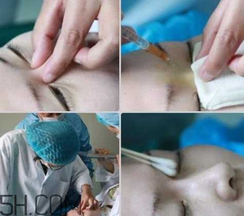 玻尿酸多少錢一支？打玻尿酸有危害嗎？