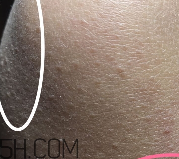 水楊酸可以去黑頭嗎？水楊酸可以去閉口嗎