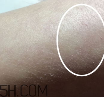 水楊酸可以去黑頭嗎？水楊酸可以去閉口嗎