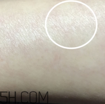 水楊酸可以去黑頭嗎？水楊酸可以去閉口嗎